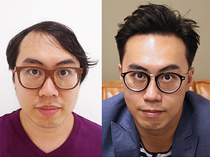Mr.S Finished His Baldness Treatment in Six Months Overall Experience Report