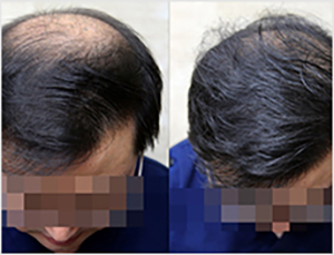  only professional Japan AGA alopecia treatment centre in Hong  Kong-Hair Transplant