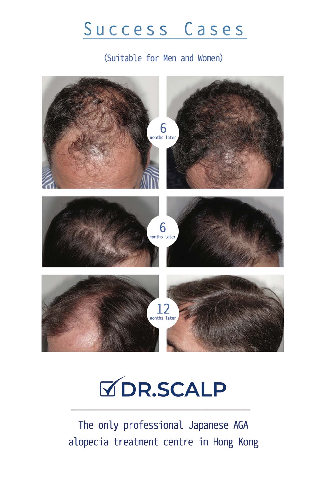 RGA®️ Hair Follicle Stem Cell Regeneration Treatment